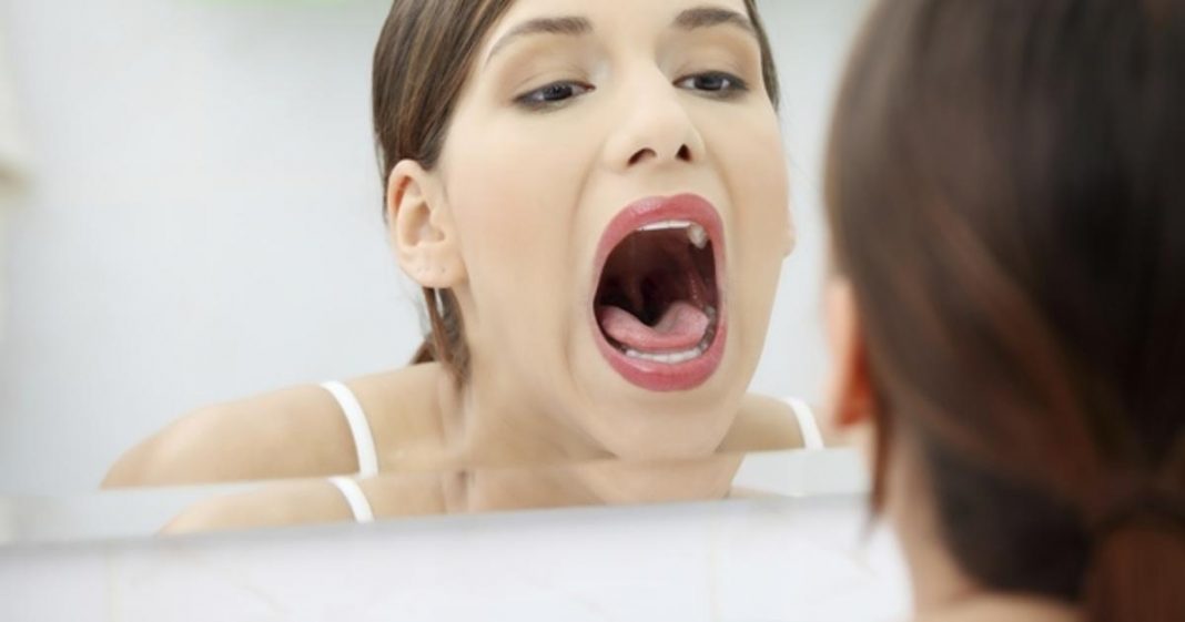 Karcinom usne šupljine